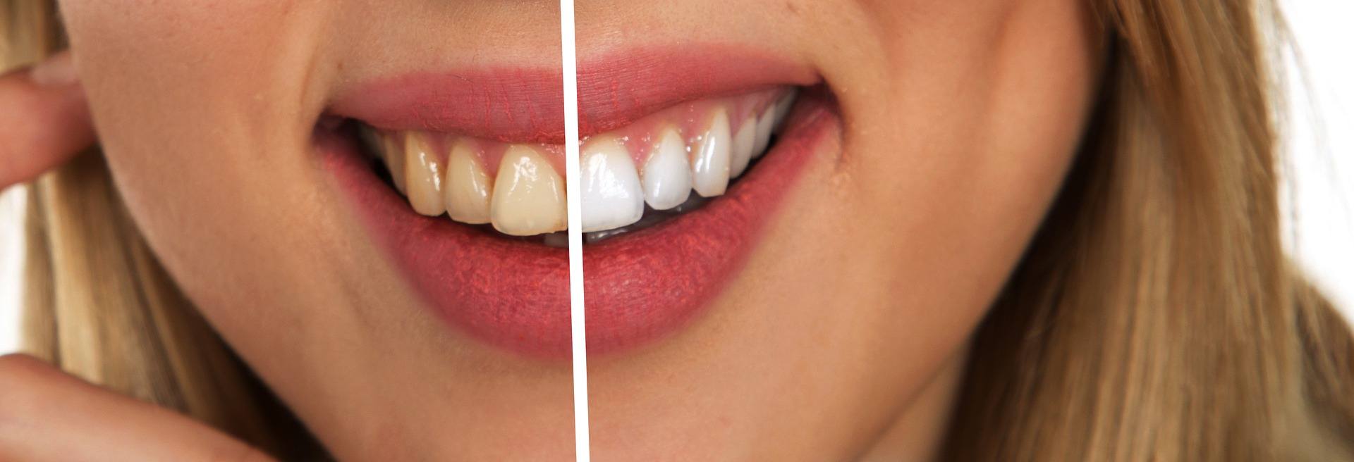Is Vaping Good or Bad For Your Teeth?